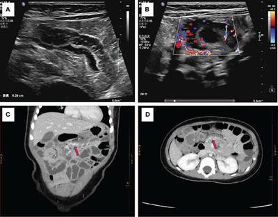 Transumbilical single-site laparoscopic treatment of small intestinal cavernous hemangioma in child: a case report